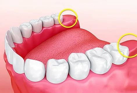 Should I Have My Wisdom Teeth Removed?
